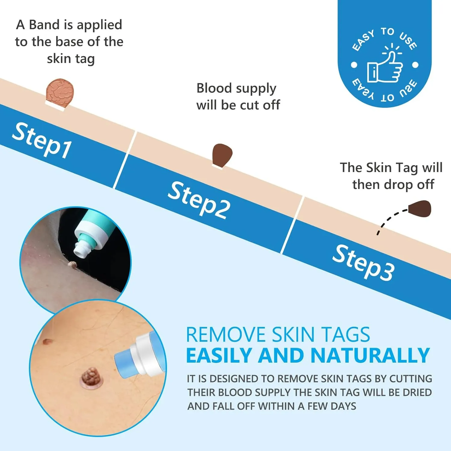 اداة إزالة الثآليل والزوائد الجلدية بسهولة