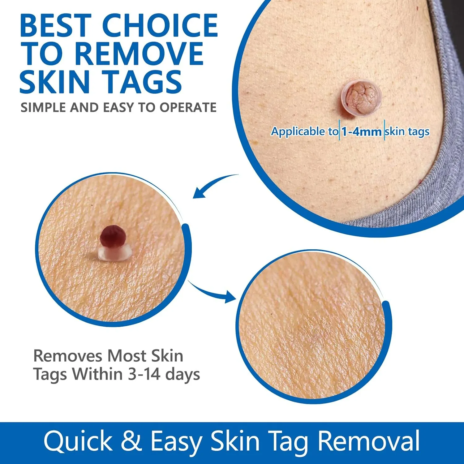 اداة إزالة الثآليل والزوائد الجلدية بسهولة