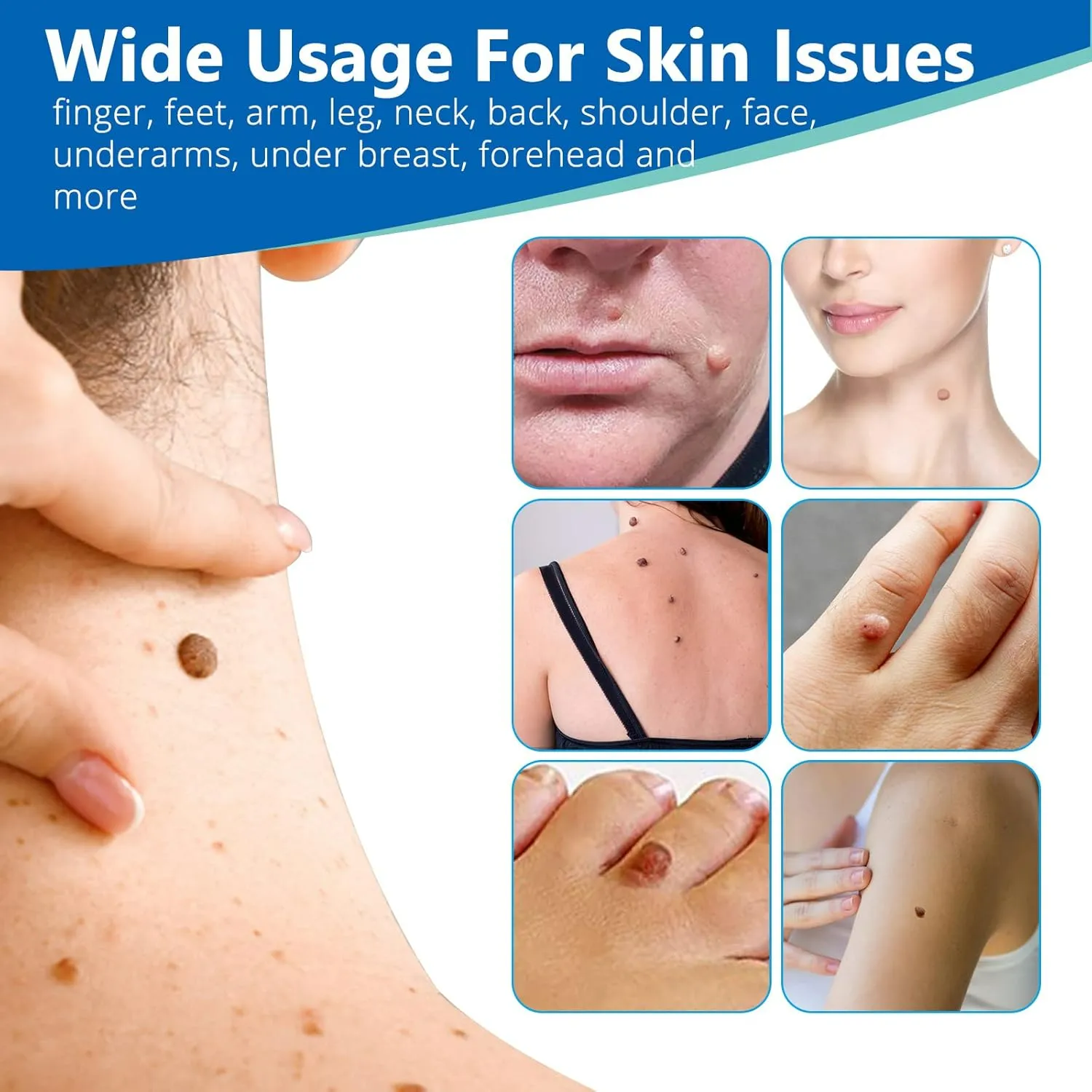 اداة إزالة الثآليل والزوائد الجلدية بسهولة